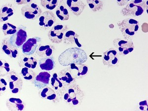 Louisiana health officials said a deadly amoeba has been detected in the water system of a parish that serves more than 12,000 people in three towns. Photo courtesy of the Centers for Disease Control and Prevention