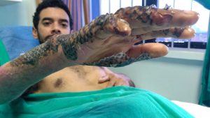 Why this Brazilian city uses tilapia fish skin to treat burn victims