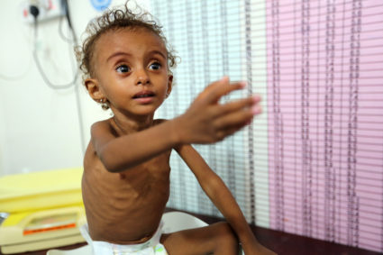 Malnourished Ferial Elias, 2, gestures as she is being weighed at a malnutrition treatment ward at al-Thawra hospital in Hodeidah, Yemen November 3, 2018. Picture taken November 3, 2018. REUTERS/Abduljabbar Zeyad