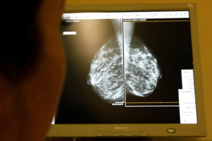 mammogram