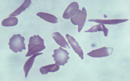 Sickle Cell Disease, Human Blood Smear with Sickled cells, 500X. This blood smear shows numerous bizarre, abnormally shaped, and sickled erythrocytes (red blood cells). This single DNA base change causes an abnormal hemoglobin which causes the erythrocytes to bend into a sickle shape that can block circulation in small blood vessels.