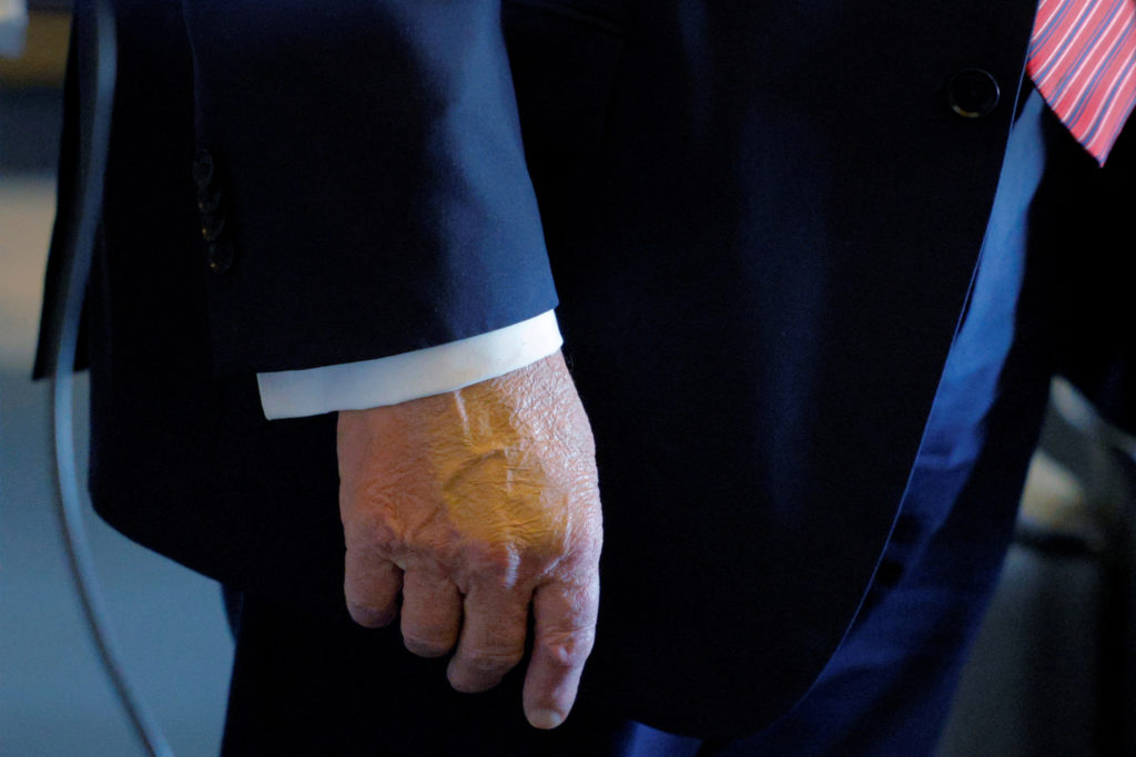 Trump diagnosed with common condition in older adults after concerns about swelling, bruises