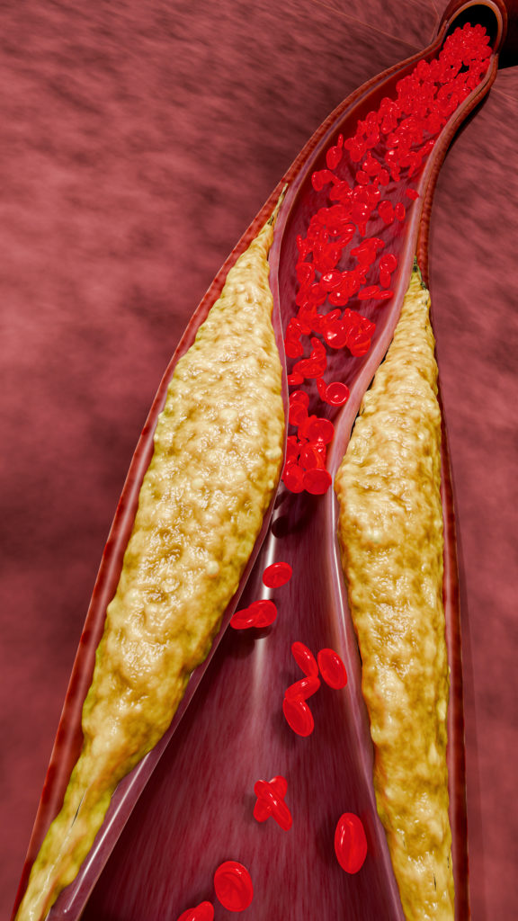 3D medical concept showing artery plaque formation due to high LDL cholesterol, poor nutrition, excessive sugar intake, al...