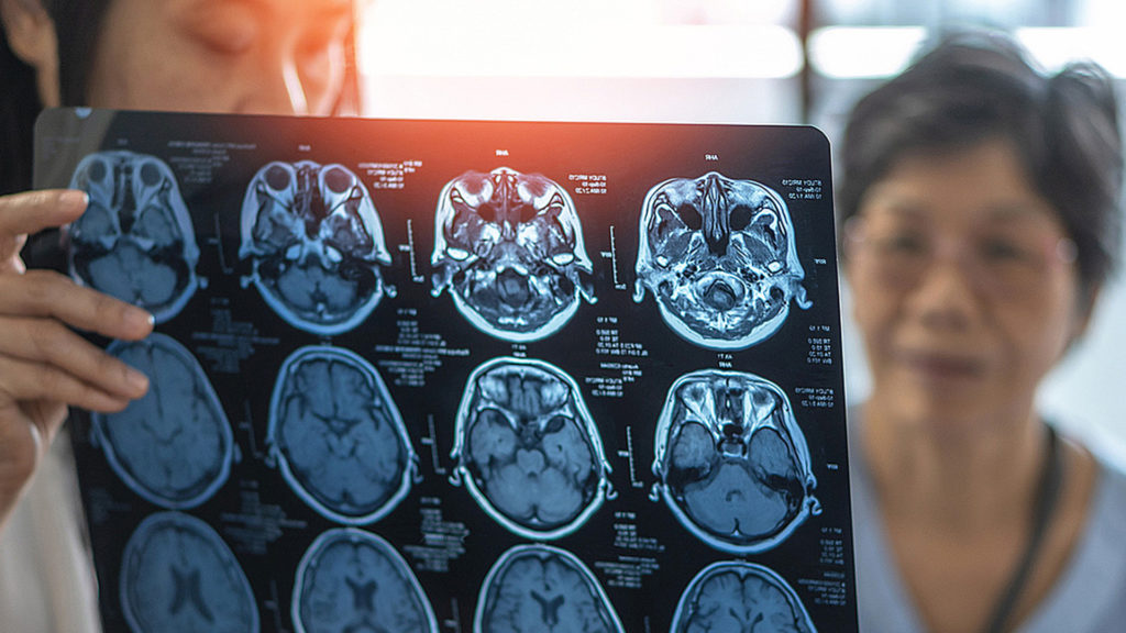 How a rare genetic mutation could unlock new ways to treat or prevent dementia - Horizons